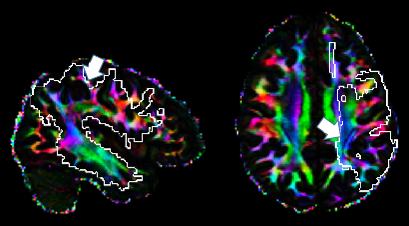 **FA corrected orientation color map on native space of one HCP subject:** The (probabilistic)  *SLF* mask on the left-hemisphere is outlined by white-colored lines. Left panel: saggital view at MNI X = -38; Right panel: axial view at MNI  Z = 30.