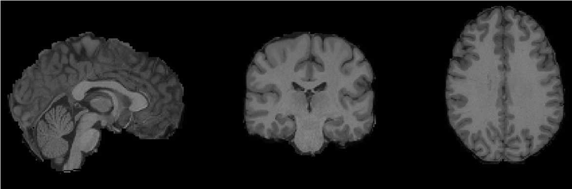 **T1w Extracted Brain of a HCP Subject:** Obtained by applying T2w extracted brain mask to T1w